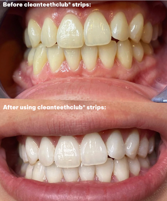 CleanTeethClub® Original 5D Whitening Strips